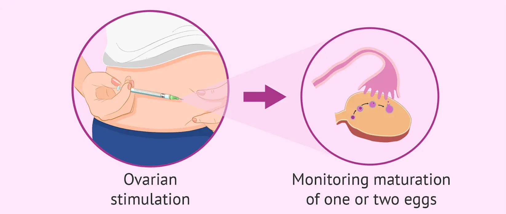 Ovarian Stimulation and Monitoring